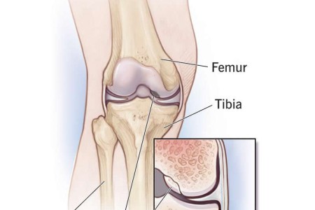 Osteochondritis Dissecans