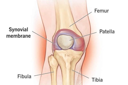 Synovitis