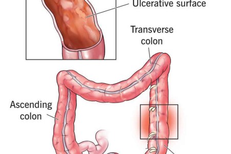 Ulcerative Colitis