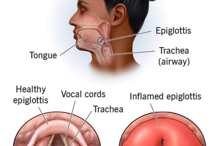 Epiglottitis