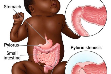 Pyloric Stenosis (HPS)