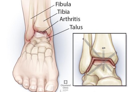 Ankle Fusion