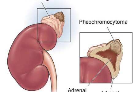Pheochromocytoma