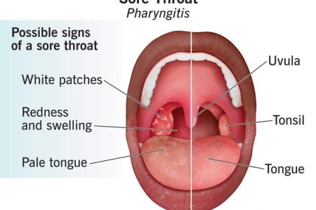 Sore Throat (Pharyngitis)