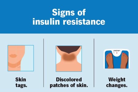 Insulin Resistance