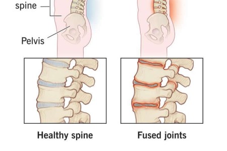 Ankylosing Spondylitis