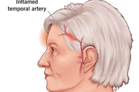 Giant Cell Arteritis (Formerly Temporal Arteritis)