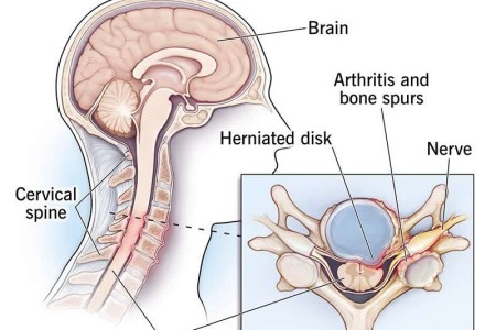 Cervical Spondylosis