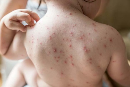 Chickenpox