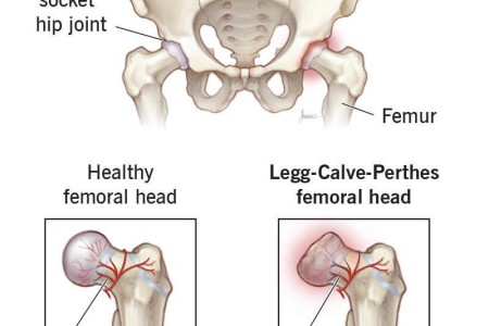 Legg-Calve-Perthes Disease