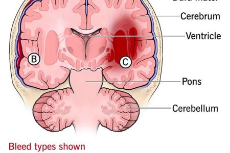 Brain Bleed, Hemorrhage (Intracranial Hemorrhage)