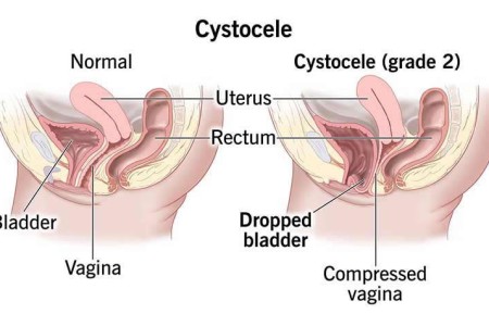 Cystocele (Fallen Bladder)