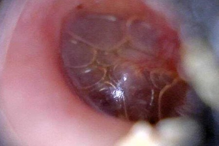 Glue Ear