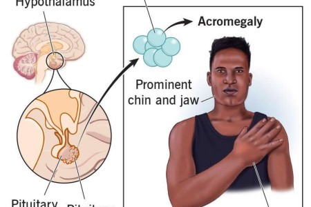 Acromegaly
