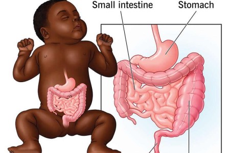 Hirschsprung's Disease