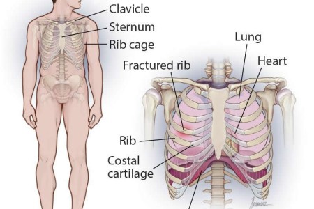 Rib Fracture