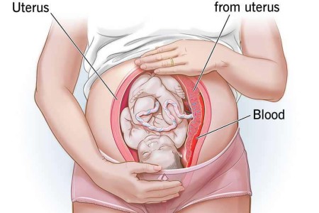 Placental Abruption