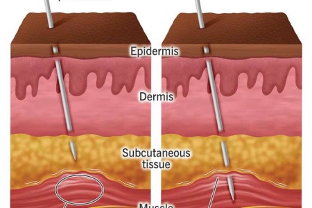 Dry Needling