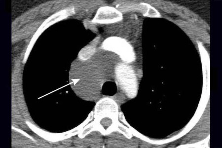 Bronchogenic Cysts