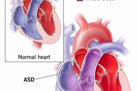 Atrial Septal Defect