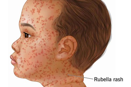 Rubella (German Measles)