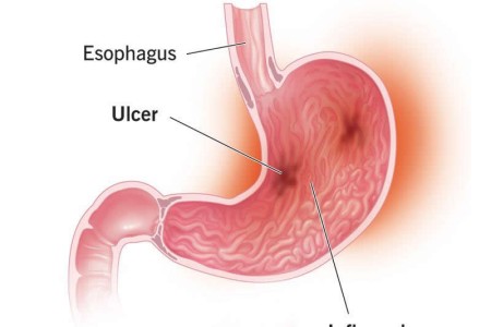 Gastritis