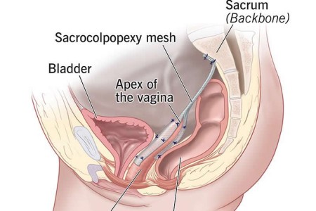 Sacrocolpopexy