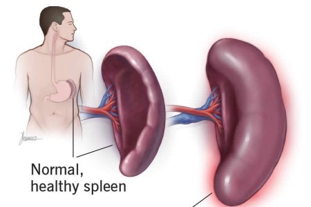 Enlarged Spleen