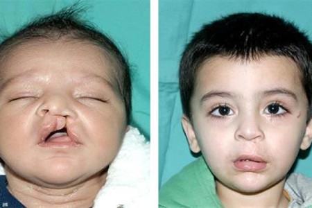 Cleft Lip/Cleft Palate