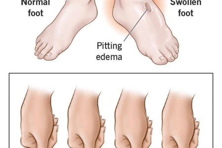 Edema