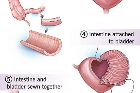 Augmentation Cystoplasty (Bladder Augmentation)