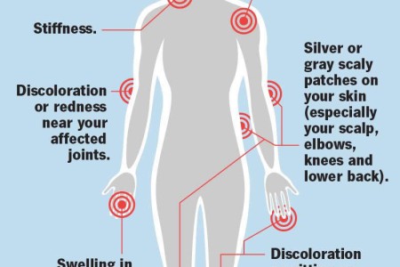 Psoriatic Arthritis