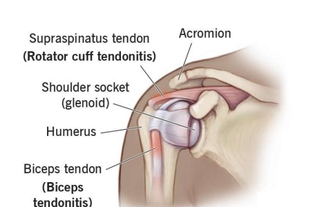 Shoulder Tendonitis