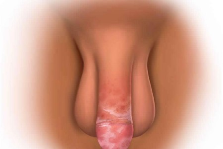 Male Yeast Infection