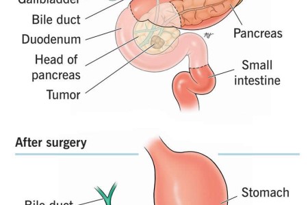 Whipple Procedure