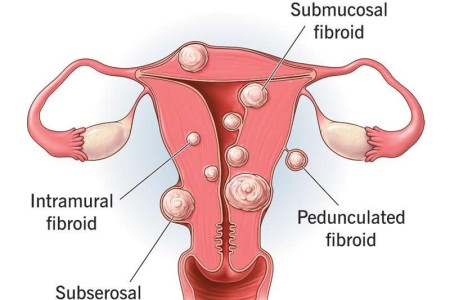 Uterine Fibroids