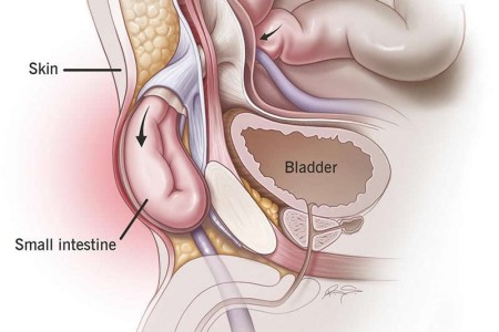 Inguinal Hernia (Groin Hernia)