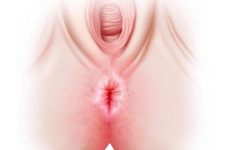 Anal Yeast Infection