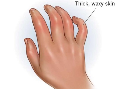 Scleroderma