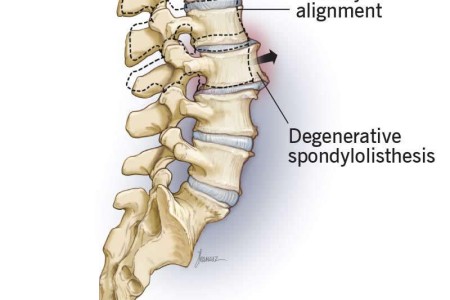 Spondylolisthesis
