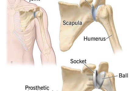 Shoulder Replacement Surgery