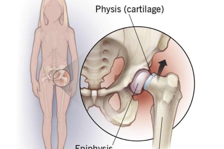 Slipped Capital Femoral Epiphysis (SCFE)