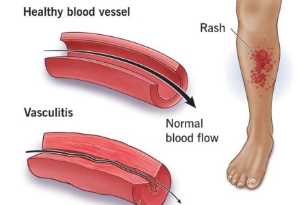 Vasculitis
