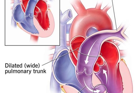 Eisenmenger Syndrome