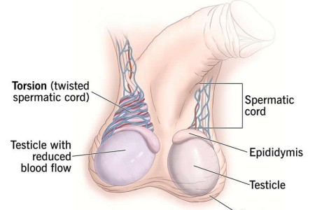 Testicular Torsion