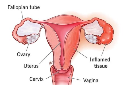 Pelvic Inflammatory Disease
