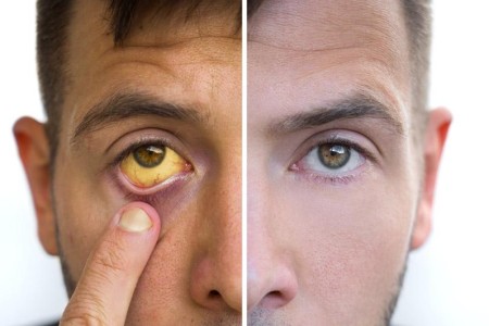 Adult Jaundice