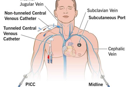 Parenteral Nutrition