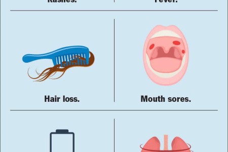 Lupus (Systemic Lupus Erythematosus)