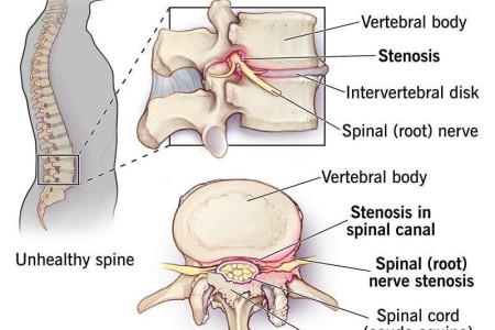 Spinal Stenosis